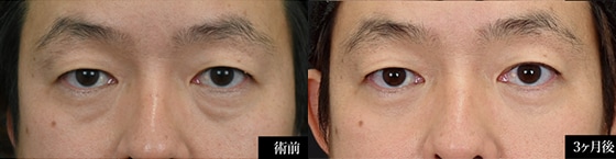 ミニ裏ハムラ法 症例写真1 Before After