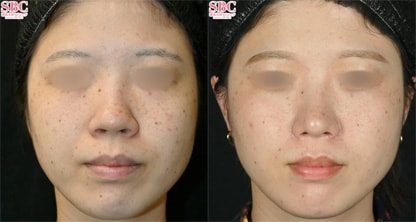 鼻フルセット 症例写真