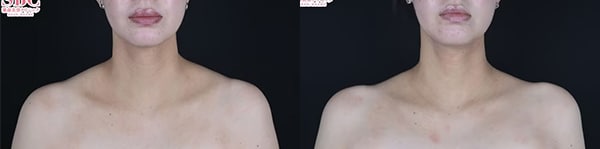 韓国製ボツリヌストキシン 症例写真1