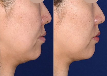 DENSITY(デンシティ) 症例写真