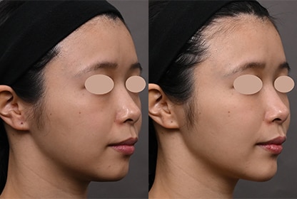 ヒアルロン酸 症例写真