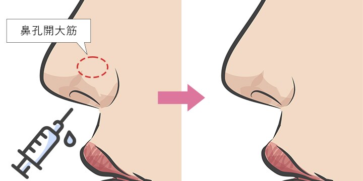 小鼻ボトックスの治療方法②