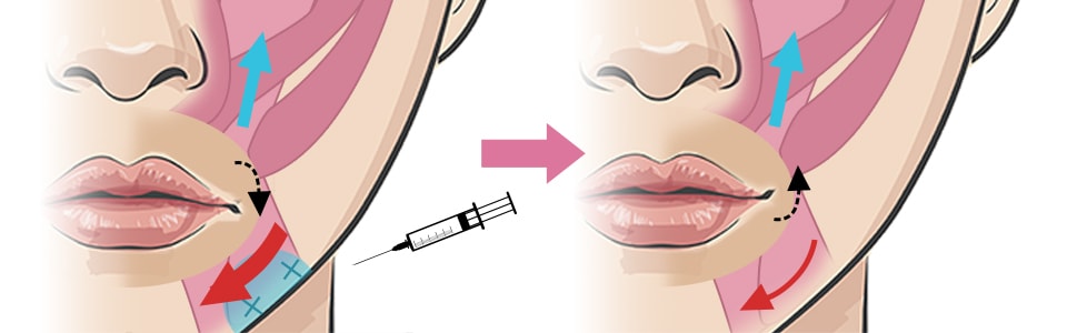 口角ボトックスで口角が引きあがる仕組み