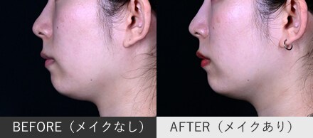 人中短縮ボトックスの症例写真(横顔)