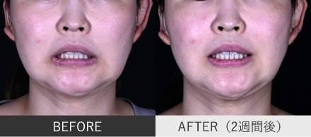 口角ボトックスの症例写真②