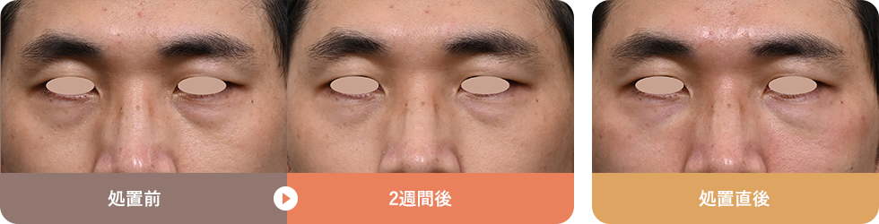 くまぴたスレッド 症例写真01