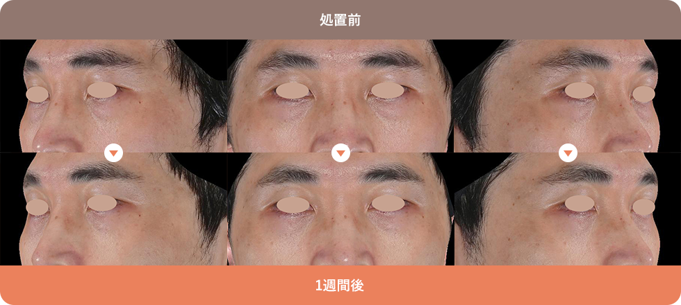 くまぴたスレッド 症例写真02