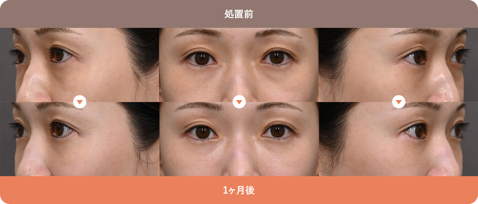 くまぴたスレッド 症例写真03