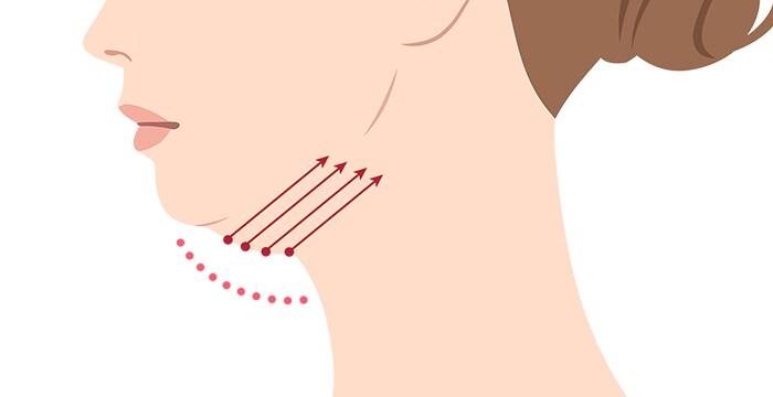 顎下すっきリフト(アンカーDXダブル)の本数の目安 イメージ