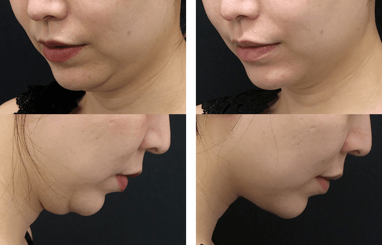 顎下すっきリフト(アンカーDXダブル)症例写真2