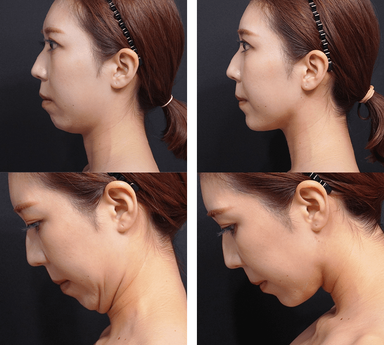 顎下すっきリフト(アンカーDXダブル)症例写真1