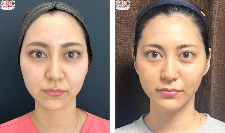 VOVリフトのPickup症例写真1