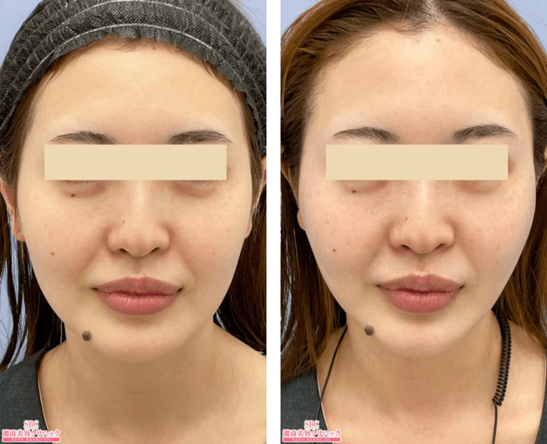 VOVリフトのPickup症例写真2