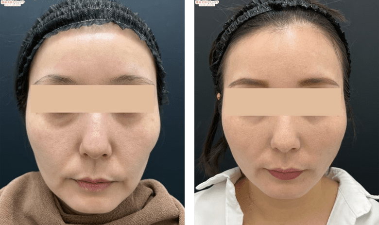 VOVリフトのPickup症例写真3