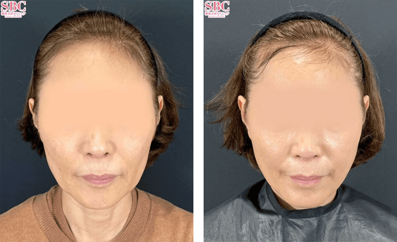 VOVリフトのPickup症例写真4