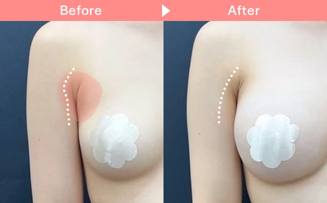 メリハリバストセット 症例写真