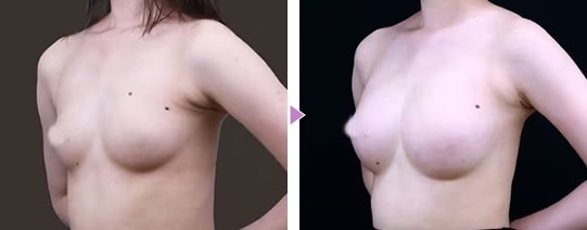 理想のボディを追求 脂肪注入豊胸の症例