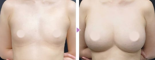 理想のボディを追求 脂肪注入豊胸の症例
