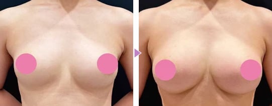 理想のボディを追求 脂肪注入豊胸の症例