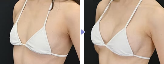 CEREFORM®(セレフォーム)症例写真