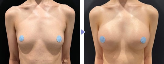 CEREFORM®(セレフォーム)症例写真