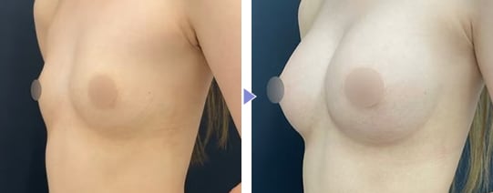 MESMO(メスモ)症例写真