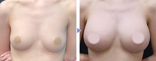 MESMO(メスモ)症例写真