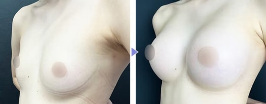 Motivaエルゴノミックス2 症例写真