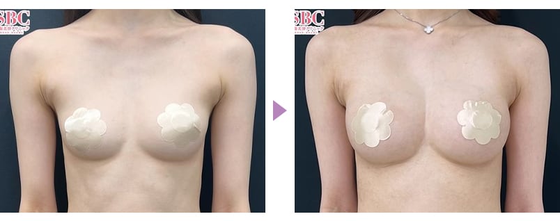 脂肪注入豊胸のピックアップ症例