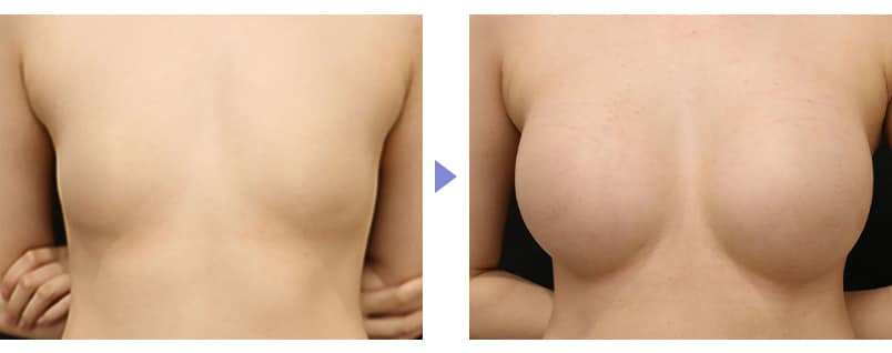 シリコンバッグ豊胸のピックアップ症例