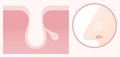 毛穴が開いてできる開き毛穴(すり鉢毛穴) イメージ1