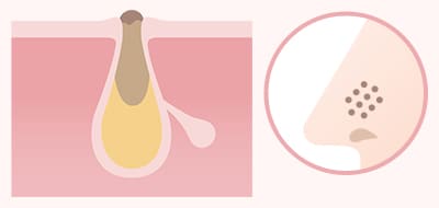 毛穴詰まりの色素沈着でできる黒ずみ毛穴 イメージ1