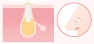 角栓が毛穴をふさいでできるつまり毛穴 イメージ1