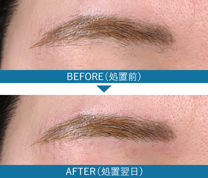 眉毛の症例写真2