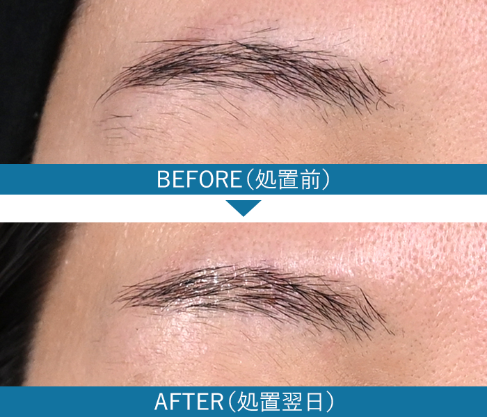 眉毛の症例写真3