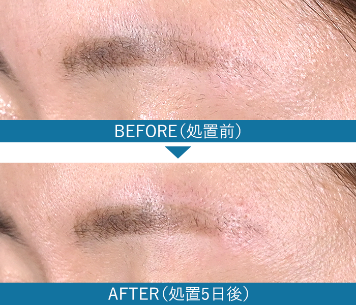 眉毛の症例写真4