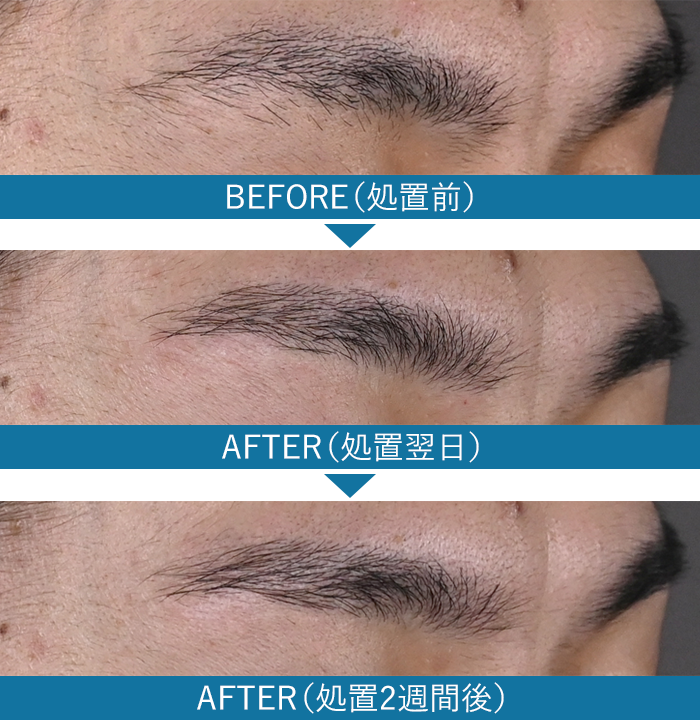 眉毛の症例写真1