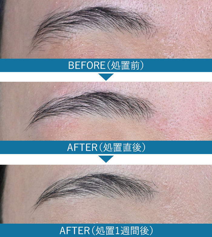 眉毛の症例写真5