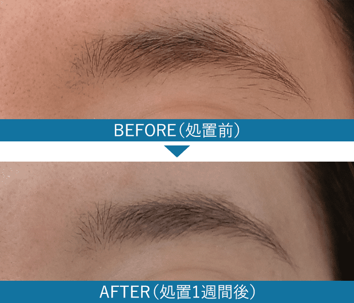 眉毛の症例写真6