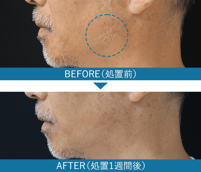 白髪の症例写真1