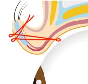 切らない眼瞼下垂 真崎式 イメージ