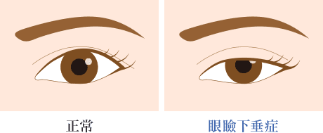 眼瞼下垂 比較