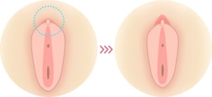 包皮を小さくしたい イメージ