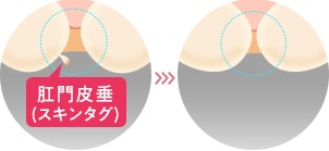肛門のたるみが気になる イメージ