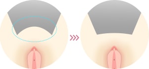 恥骨上のふくらみが気になる イメージ