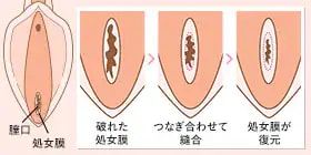 処女膜を再生させたい イメージ