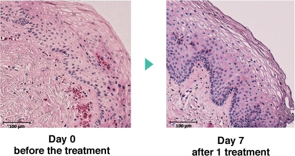 ジュリエットレーザー イメージ