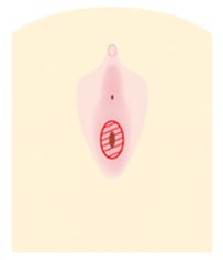 膣内照射 イメージ2