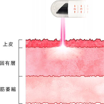 レーザー治療 Before