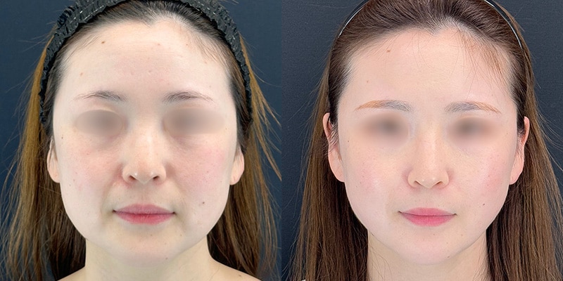 小顔施術 症例写真26